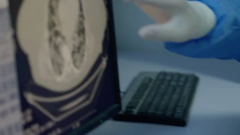 What does a human lung look like with a covid-19 Stock Footage 130346693