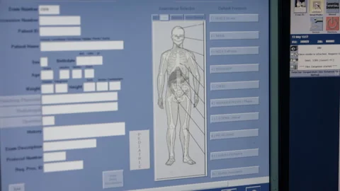 What does a human lung look like with a covid-19 Stock Footage 130348671