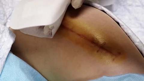 What the suture looks like 2 months after a total hip replacement, close up Stock Footage 258846953