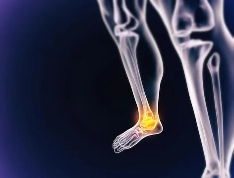 When inflammation strikes. A cgi view of an inflamed joint isolated on blue. Illustrazione stock