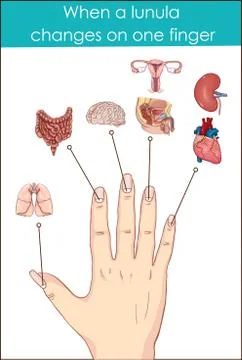 When a lunula  changes on one finger Stock Illustration