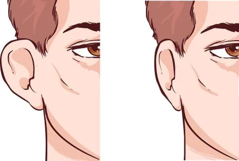 White backround Vector illustration of a Ear Pinnin Otoplasty Stock Illustration