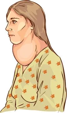 White backround Vector illustration of a goiter Stock Illustration