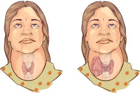 White backround Vector illustration of a goiter Stock Illustration