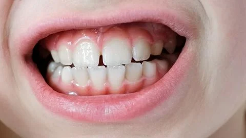 The white child teeth with a visible gap between two front teeth Stock Photos