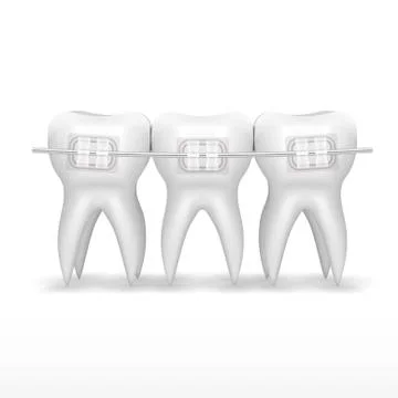 White Clear Teeth With Ceramic Braces Stock-Illustration