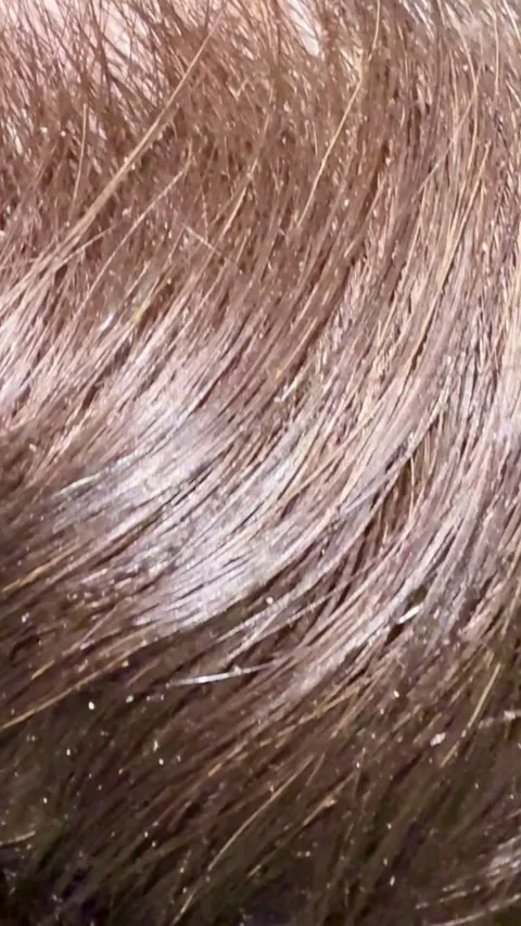 White dandruff flakes scattered throughout messy human brown hair Vídeo Stock 334592738
