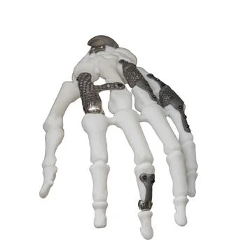 White hand model with metallic implants, detailed anatomical structure, neu.. Stock Photos