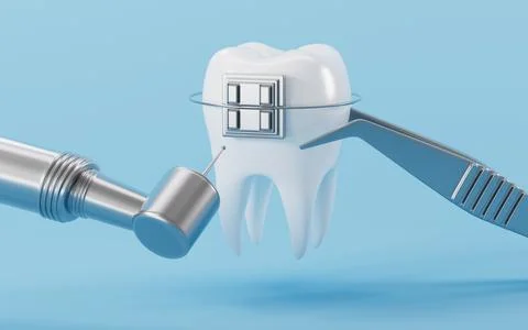 White teeth with braces on the blue background. 3d rendering. Stock Illustration