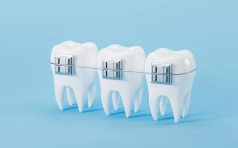 White teeth with braces on the blue background. 3d rendering. Stock Illustration