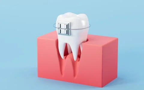 White teeth with braces on the blue background. 3d rendering. Stock Illustration