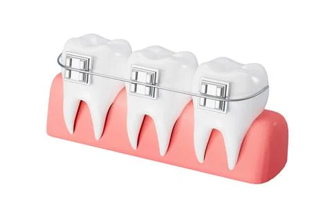 White teeth with braces on the blue background. 3d rendering. Stock Illustration
