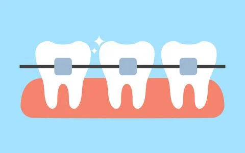 White teeth with dental braces vector flat illustration. Alignment of bite of Stock Illustration