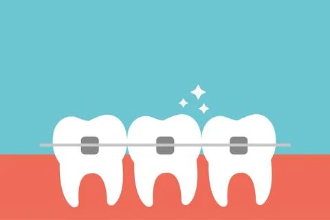White teeth with dental braces vector flat illustration. Illustrazione stock