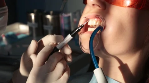 Whitening teeth closeup in slow motion Stock Footage 60912200