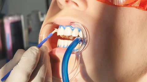 Whitening teeth closeup in slow motion Stock Footage 60913047