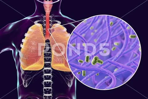 Whooping cough bacteria Bordetella pertussis in human airways Stock Illustration