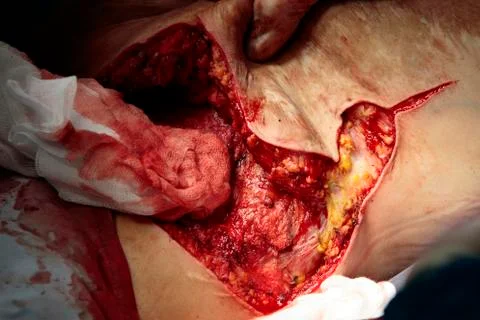 Wide access to the wound Photos