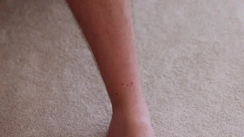 Wide shot of multiple ticks suckign blood from a mans leg after a hike Stock Footage 310764730