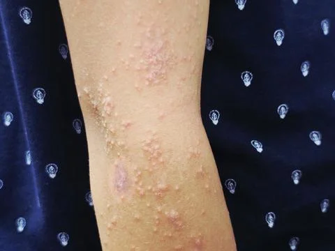 A widespread, clustered eruption of small, fluid-filled blisters vesicles a.. Stock-Fotos