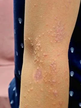 A widespread, clustered eruption of small, fluid-filled blisters vesicles a.. Foto stock