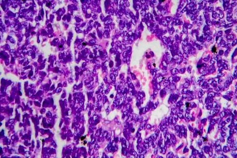 Wilms tumor, light micrograph Stock Photos