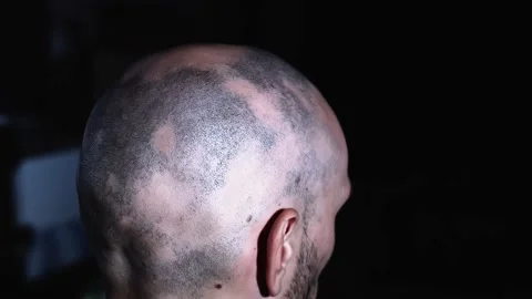 Window light shine onto a person's bald head, going through chemotherapy Stock Footage 137609040
