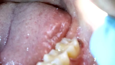 Wisdom teeth that have just started to grow Stock-Footage 327885934