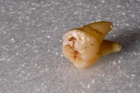 Wisdom teeth Stock Photos