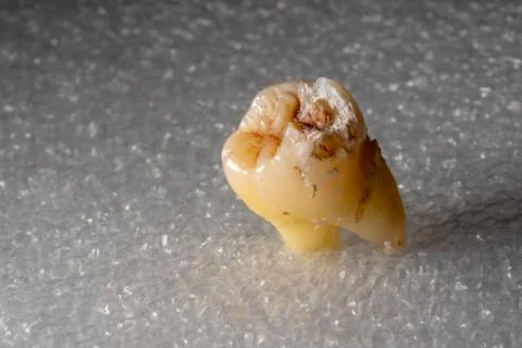 Wisdom teeth Stock Photos