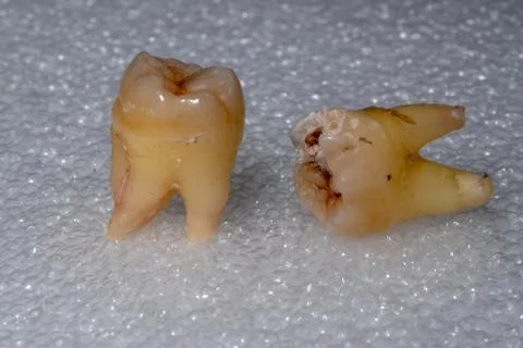 Wisdom teeth Stock Photos