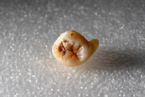 Wisdom teeth 库存照片