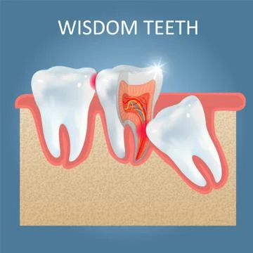 Wisdom teeth problems vector poster design template Stock Illustration