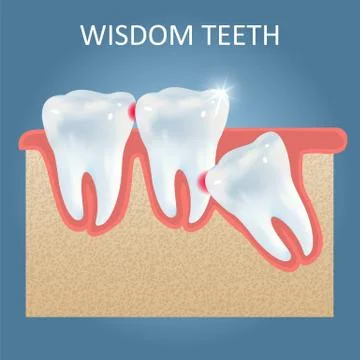 Wisdom teeth problems vector poster design template Stock Illustration