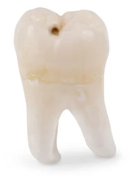 Wisdom tooth with cavity Foto stock