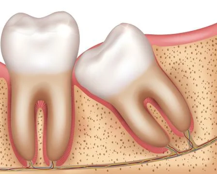 Wisdom tooth eruption Illustrazione stock