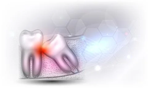 Wisdom tooth eruption problems Stock Illustration