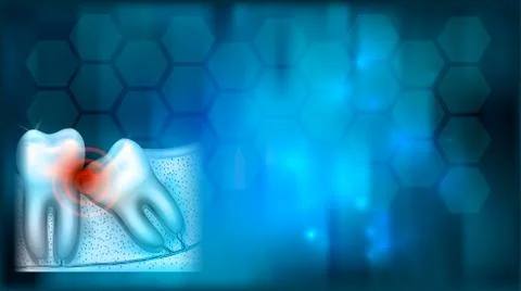 Wisdom tooth eruption problems Stock Illustration