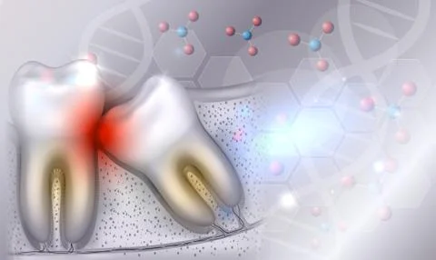 Wisdom tooth eruption problems Stock Illustration