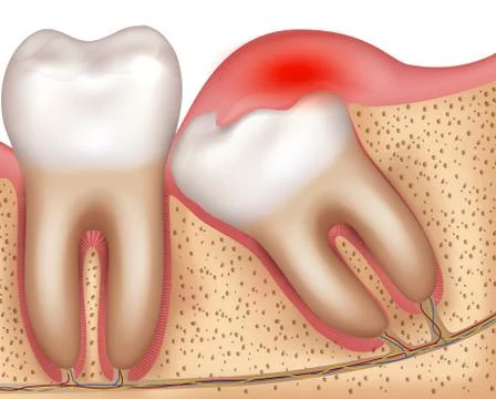Wisdom tooth eruption problems inflamed gums Stock Illustration