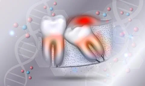 Wisdom tooth eruption problems inflamed gums Stock Illustration