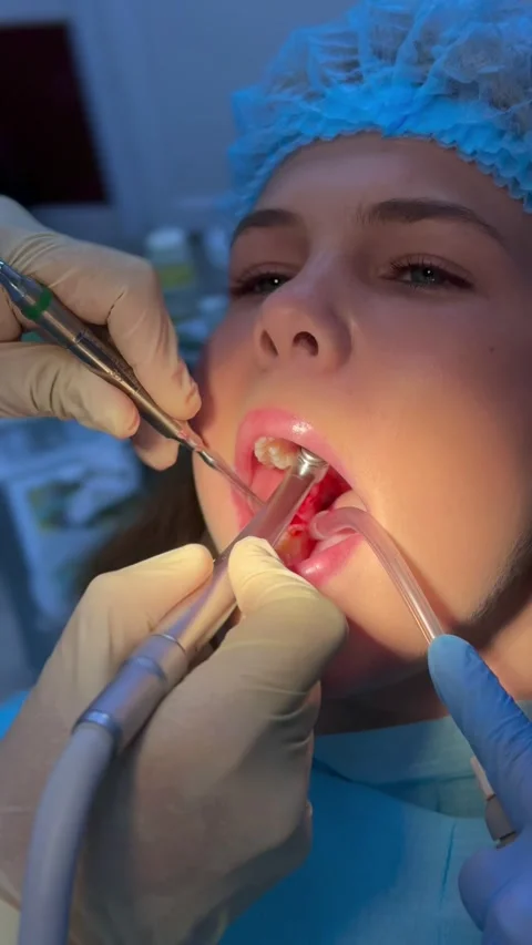Wisdom tooth extraction in a young girl, dental forceps, surgical instrumen.. Stock Footage 344442704