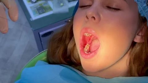 Wisdom tooth extraction in a young girl, dental forceps, surgical instrumen.. Stock Footage 344442873