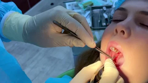 Wisdom tooth extraction in a young girl, dental forceps, surgical instrumen.. Stock Footage 344442877