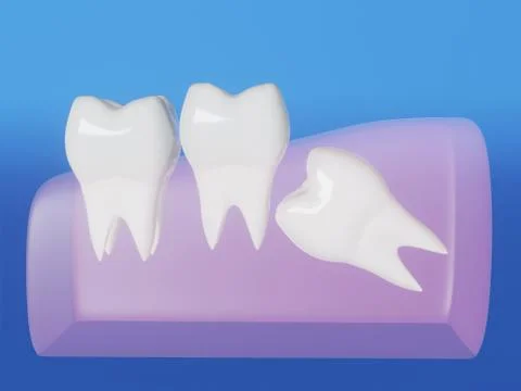 Wisdom tooth grows wrong Stock Illustration