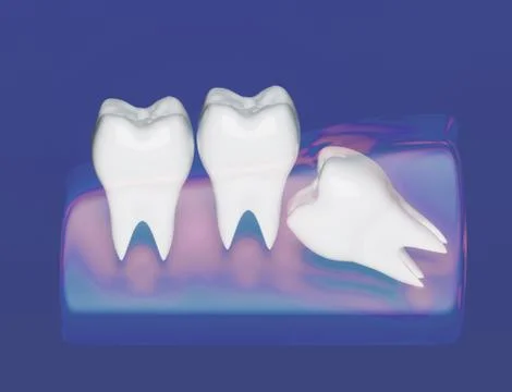 Wisdom tooth grows wrong, wisdom tooth problem Stock Illustration