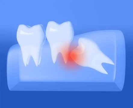 Wisdom tooth grows wrong, wisdom tooth problem, horizontal position Stockillustratie