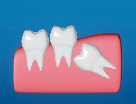 Wisdom tooth grows wrong, wisdom tooth problem, horizontal position Illustrazione stock