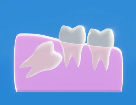 Wisdom tooth grows wrong, wisdom tooth problem 스톡 일러스트
