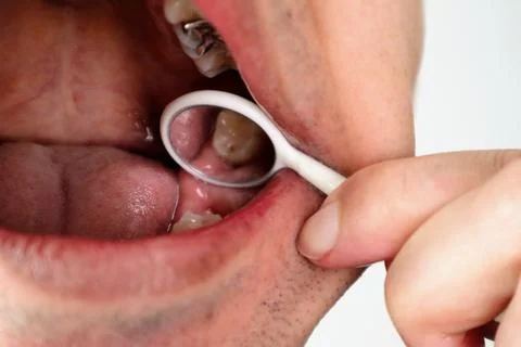 A wisdom tooth that has started to come in a little. Stock Photos